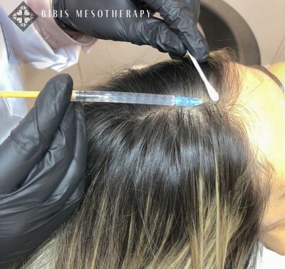 Hair Mesotherapy